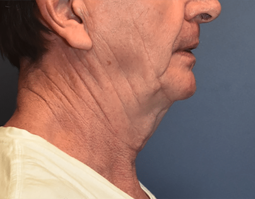 Before Image: Neck Lift - right-side