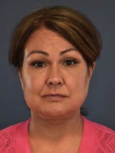 After Image: Necklift and Facelift