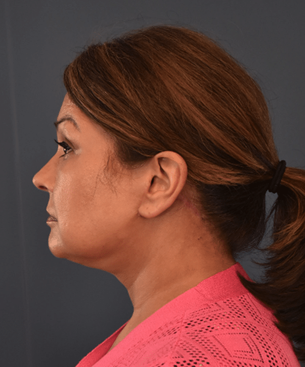 After Image: Necklift and Facelift - left-side