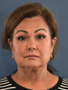 Before Image: Necklift and Facelift