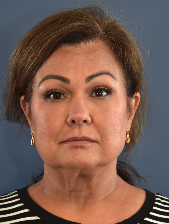 Before Image: Necklift and Facelift - front