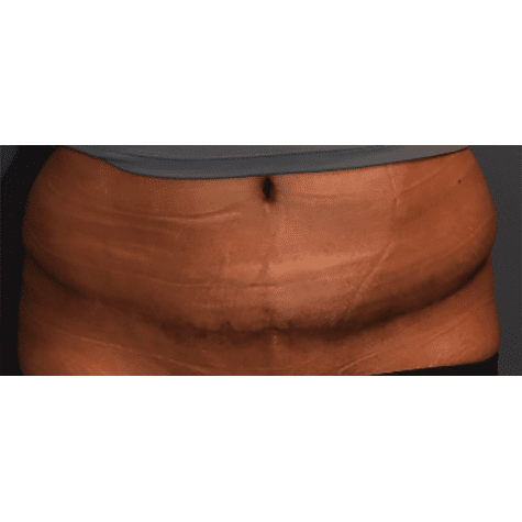 After Image: Tummy Tuck (Abdominoplasty) - front