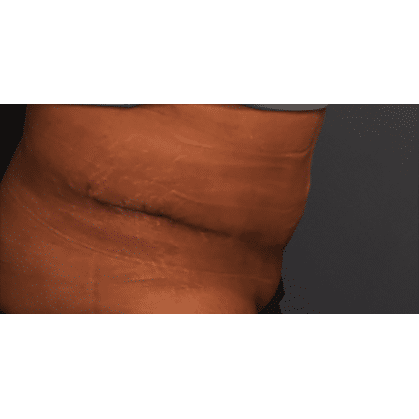 After Image: Tummy Tuck (Abdominoplasty) - right-side