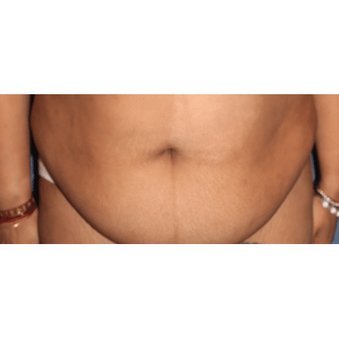 Before Image: Tummy Tuck (Abdominoplasty) - front