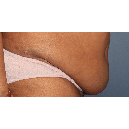 Before Image: Tummy Tuck (Abdominoplasty) - right-side