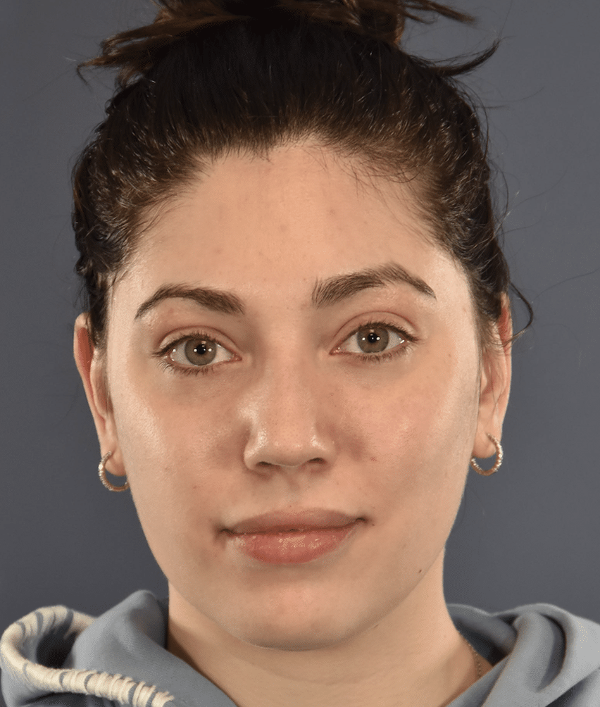 After Image: Rhinoplasty - front