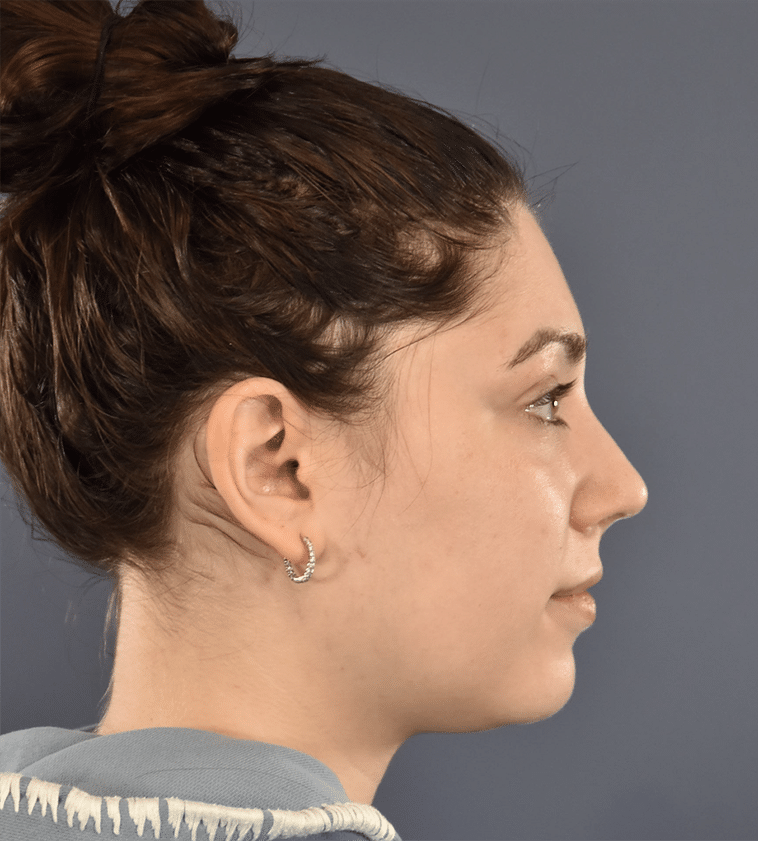 After Image: Rhinoplasty - right-side