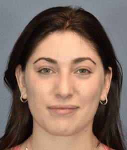 Before Image: Rhinoplasty