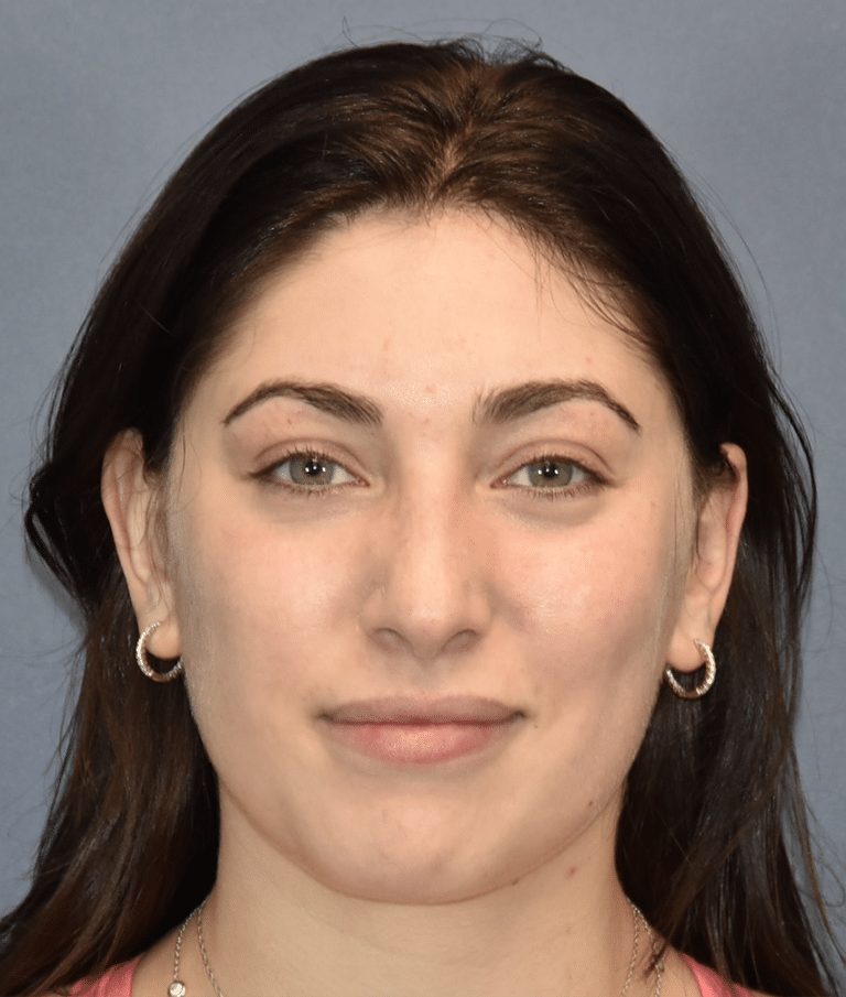 Before Image: Rhinoplasty - front