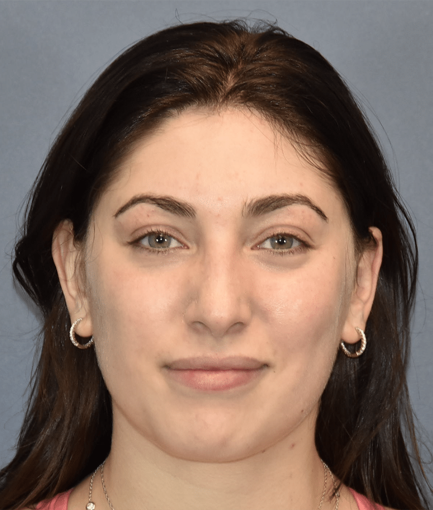 Before Image: Rhinoplasty - front