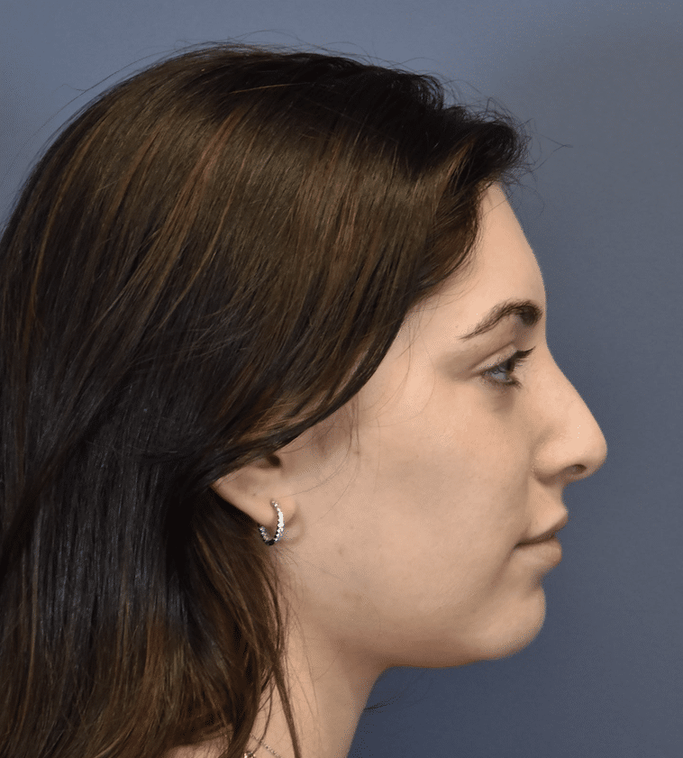 Before Image: Rhinoplasty - right-side