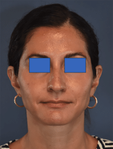 After Image: Rhinoplasty
