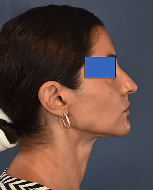 After Image: Rhinoplasty - right-side
