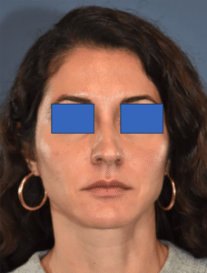 Before Image: Rhinoplasty