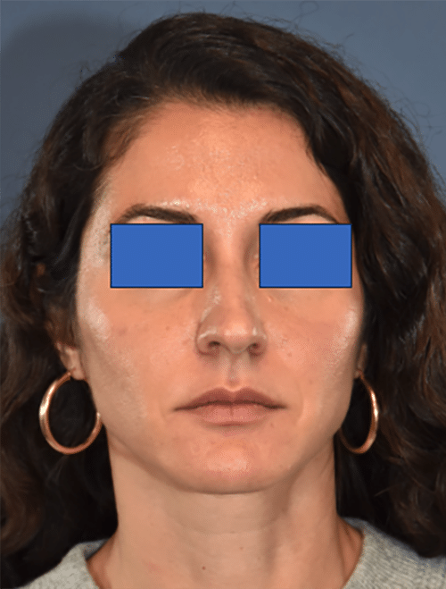 Before Image: Rhinoplasty - front