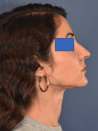 Before Image: Rhinoplasty - right-side