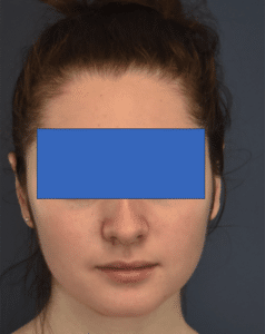 After Image: Otoplasty