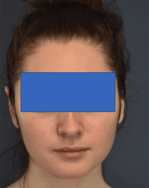 After Image: Otoplasty - front