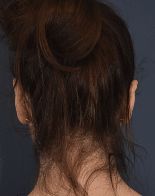 After Image: Otoplasty - back
