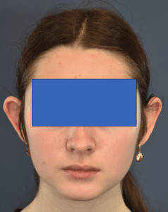 Before Image: Otoplasty
