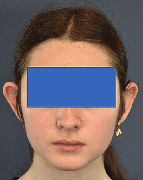 Before Image: Otoplasty - front