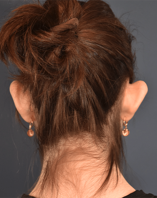 Before Image: Otoplasty - back
