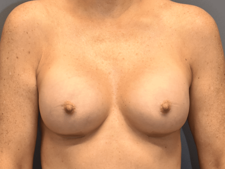 After Image: Breast Augmentation - front