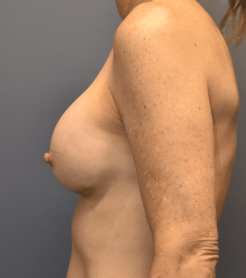 After Image: Breast Augmentation - left-side