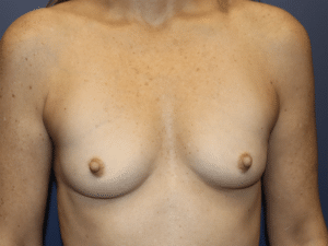 Before Image: Breast Augmentation