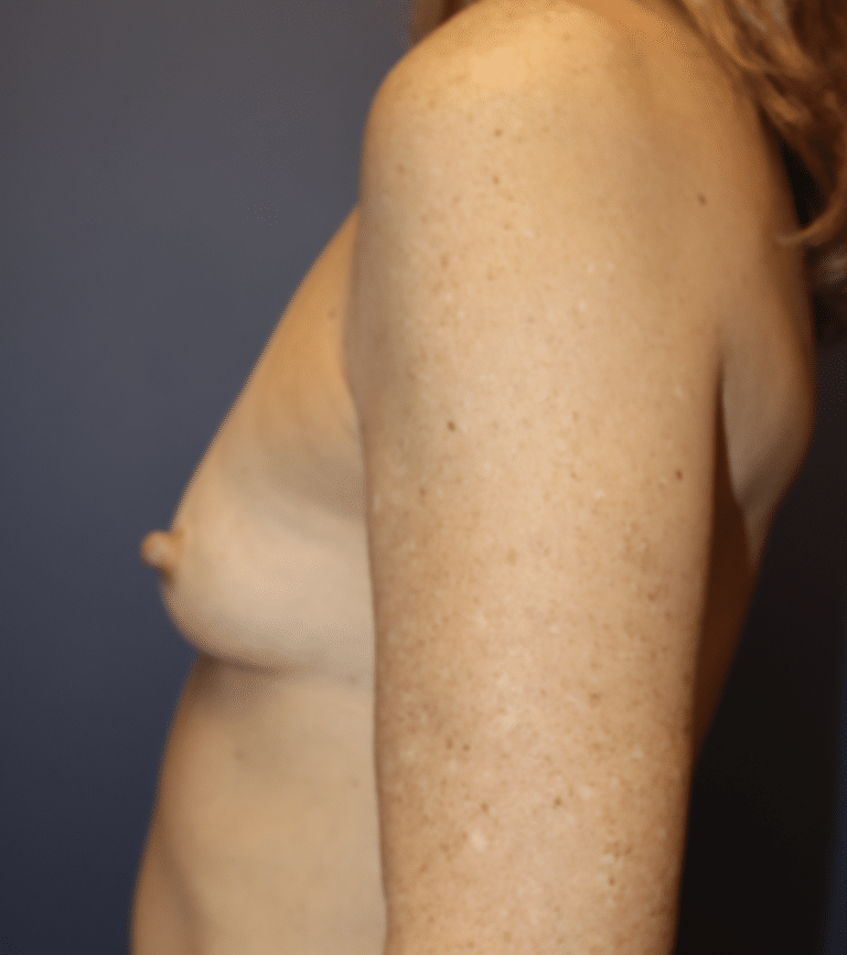 Before Image: Breast Augmentation - left-side