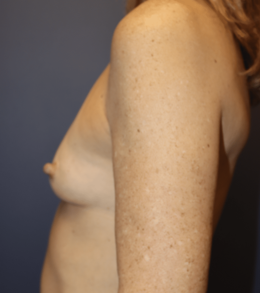 Before Image: Breast Augmentation - left-side