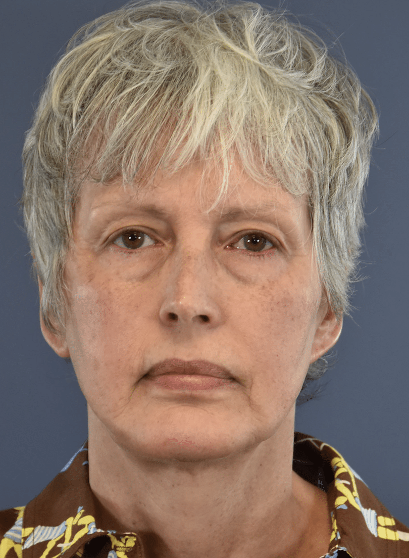 After Image: Facelift and Neck Lift - front