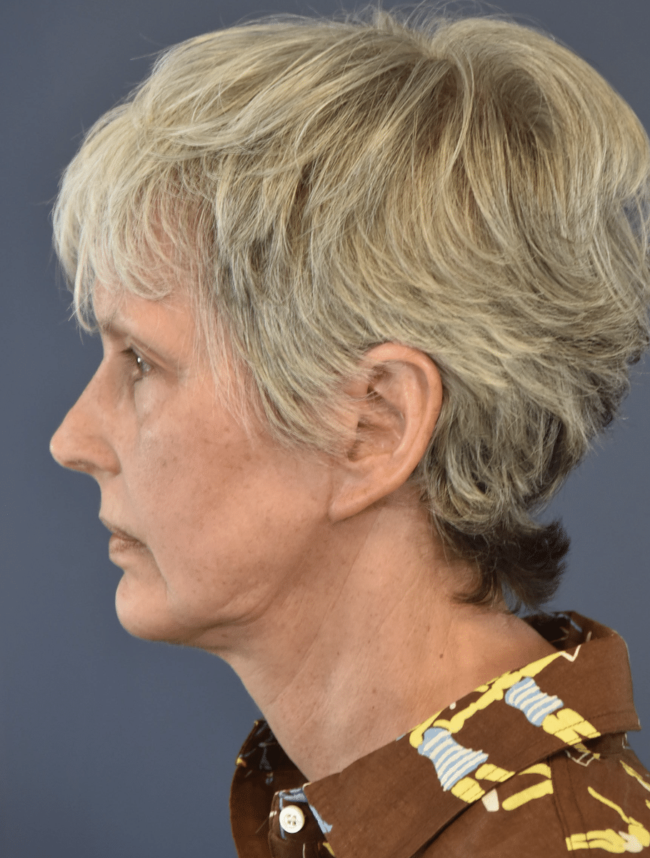 After Image: Facelift and Neck Lift - left-side