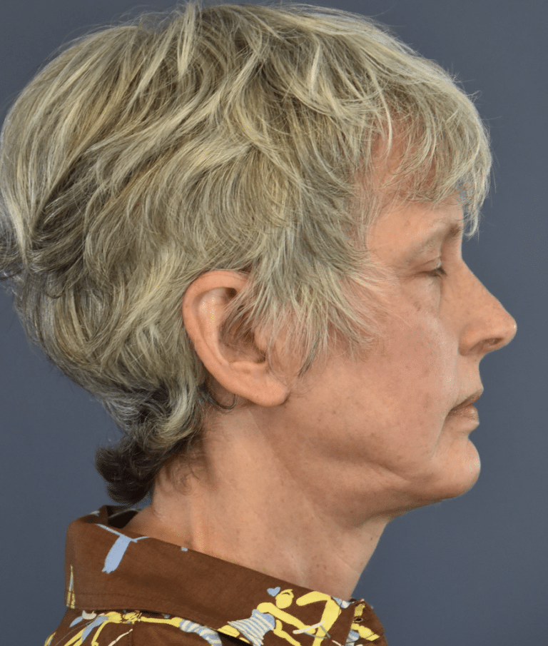 After Image: Facelift and Neck Lift - right-side
