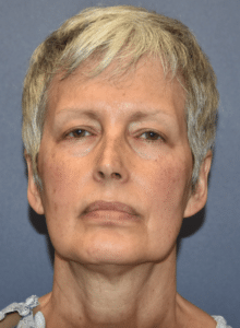 Before Image: Facelift and Neck Lift