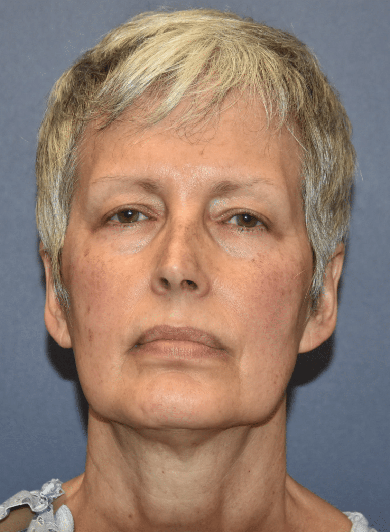 Before Image: Facelift and Neck Lift - front