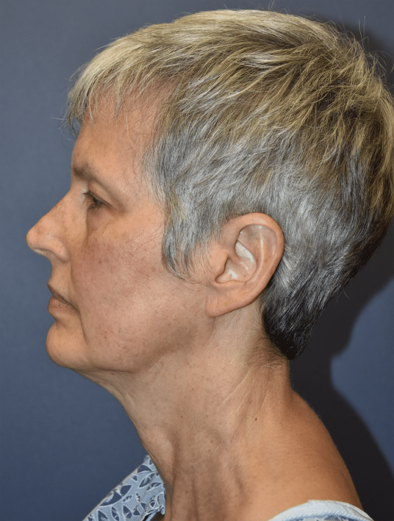 Before Image: Facelift and Neck Lift - left-side