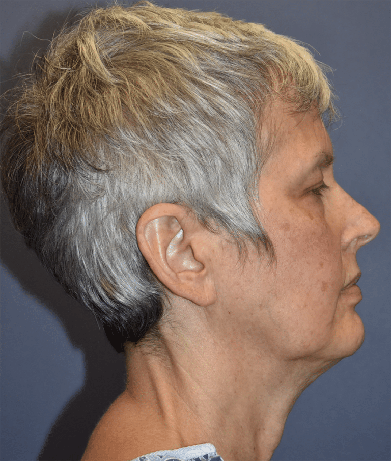 Before Image: Facelift and Neck Lift - right-side