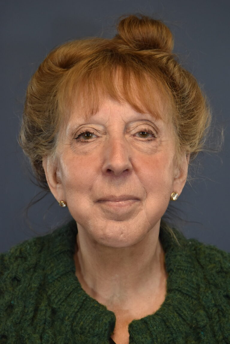 After Image: Facelift and Neck Lift - front