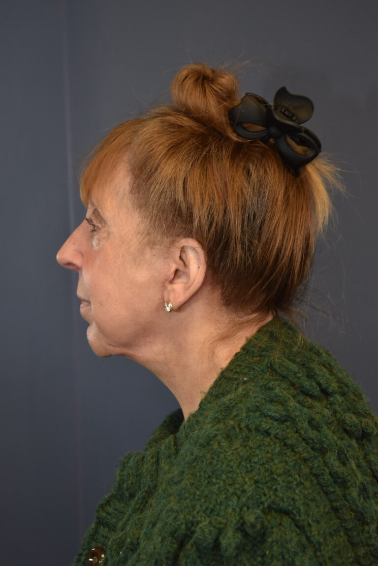 After Image: Facelift and Neck Lift - left-side