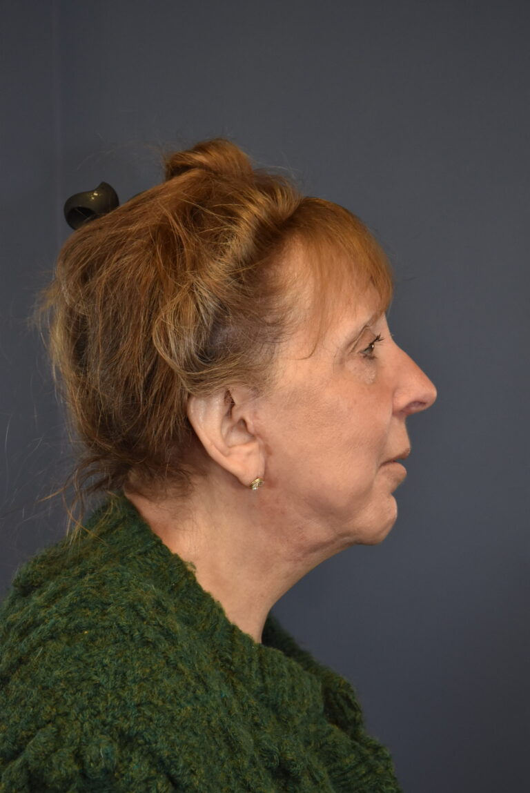 After Image: Facelift and Neck Lift - right-side