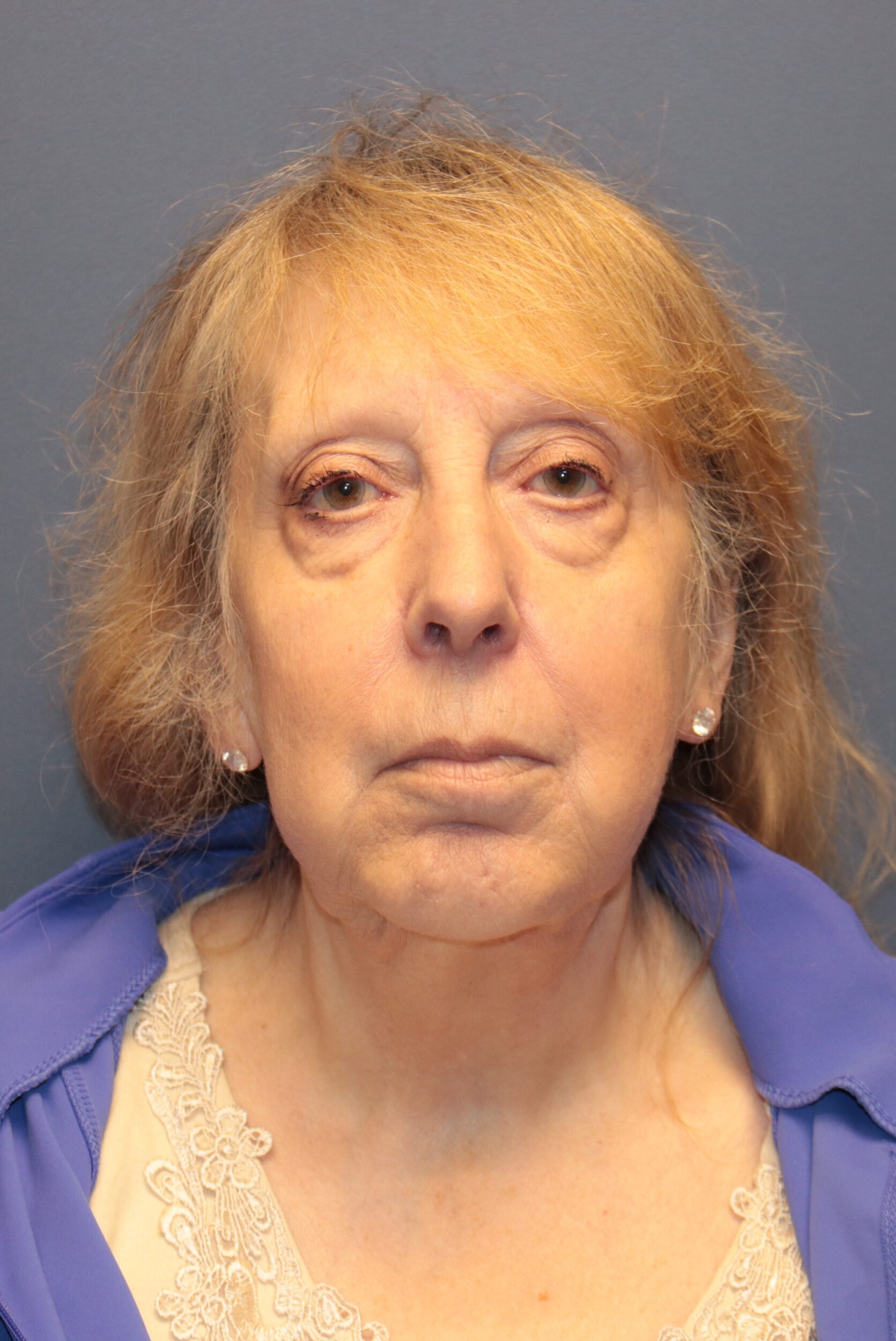 Before Image: Facelift and Neck Lift - front