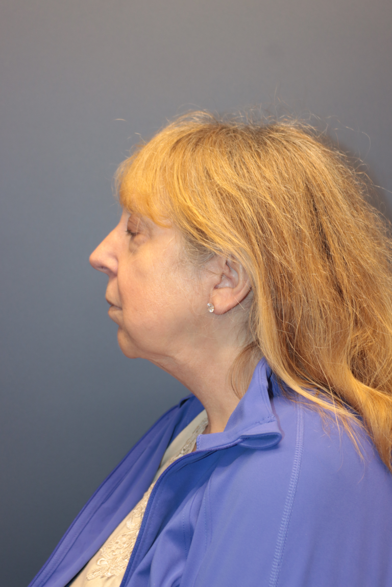 Before Image: Facelift and Neck Lift - left-side