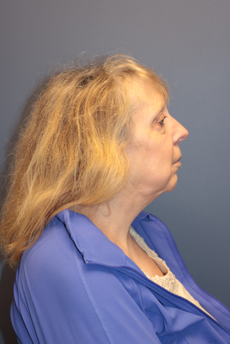 Before Image: Facelift and Neck Lift - right-side