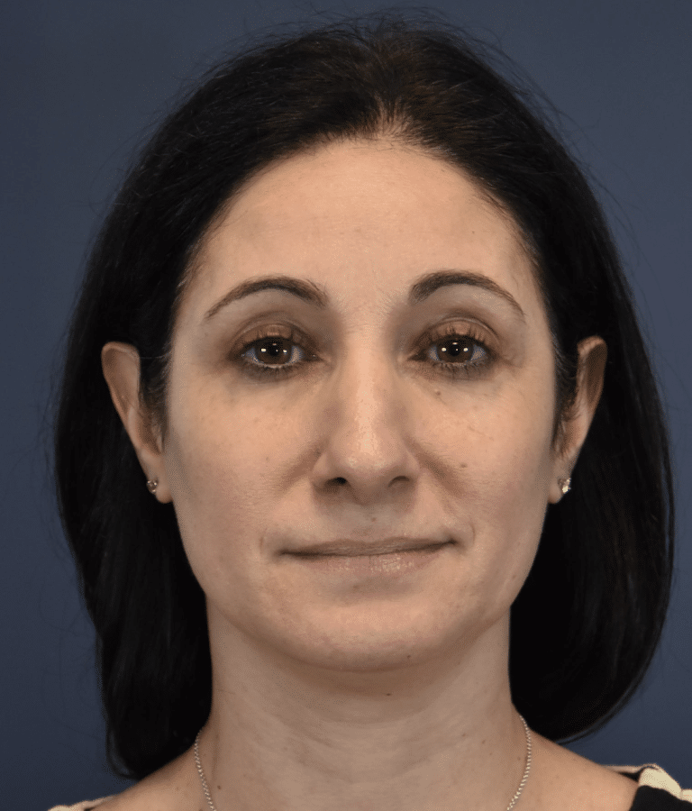 After Image: Rhinoplasty - front