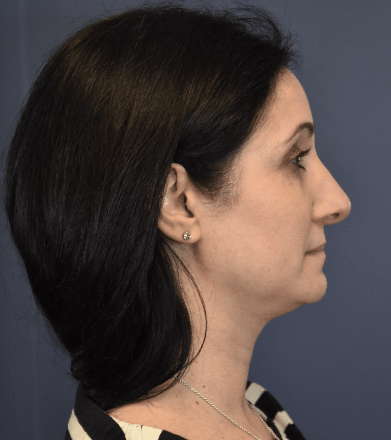 After Image: Rhinoplasty - right-side