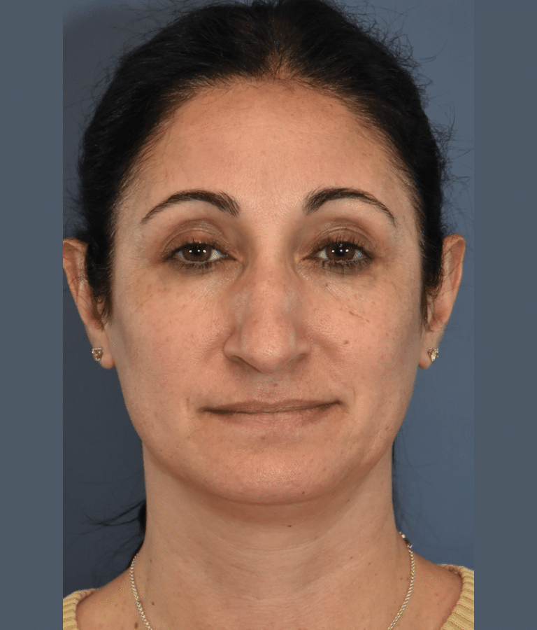 Before Image: Rhinoplasty - front