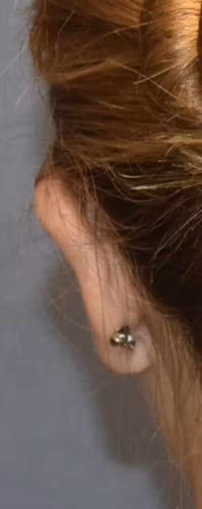 Otoplasty in Boston, MA