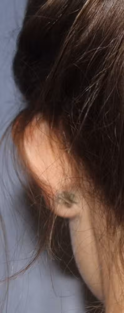 Otoplasty in Boston, MA
