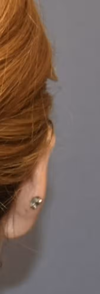 Otoplasty in Boston, MA